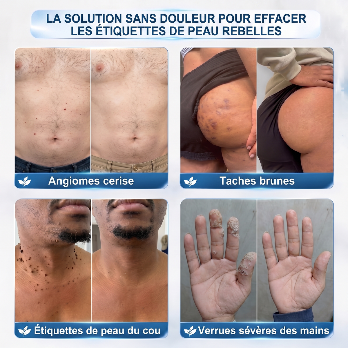 【 Dernier jour : -70 % 🔥】🇫🇷 𝐇𝐞𝒂𝒍𝗿𝗶𝙯𝙚®🦋 𝑷𝒂𝒕𝒄𝒉 2-𝒆𝒏-1 à 𝒎𝒊𝒄𝒓𝒐-𝒂𝒊𝒈𝒖𝒊𝒍𝒍𝒆𝒔 & 𝒉𝒚𝒅𝒓𝒐𝒄𝒐𝒍𝒍𝒐ï𝒅𝒆 | Aide à réduire l’apparence des grains de beauté, verrues, acné et étiquettes cutanées | Patchs invisibles visage & corps.