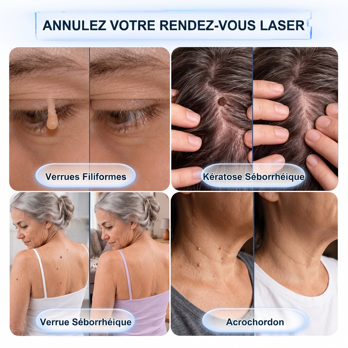 🔥 Plus que 10 paquets disponibles ! 30 % de réduction supplémentaire ! 𝐇𝐞𝒂𝒍𝗿𝗶𝙯𝙚® Patch 2-en-1 à micro-aiguilles & hydrocolloïde | Aide à réduire l’apparence des grains de beauté, verrues, acné et étiquettes cutanées | Patchs invisibles visage & corps.
