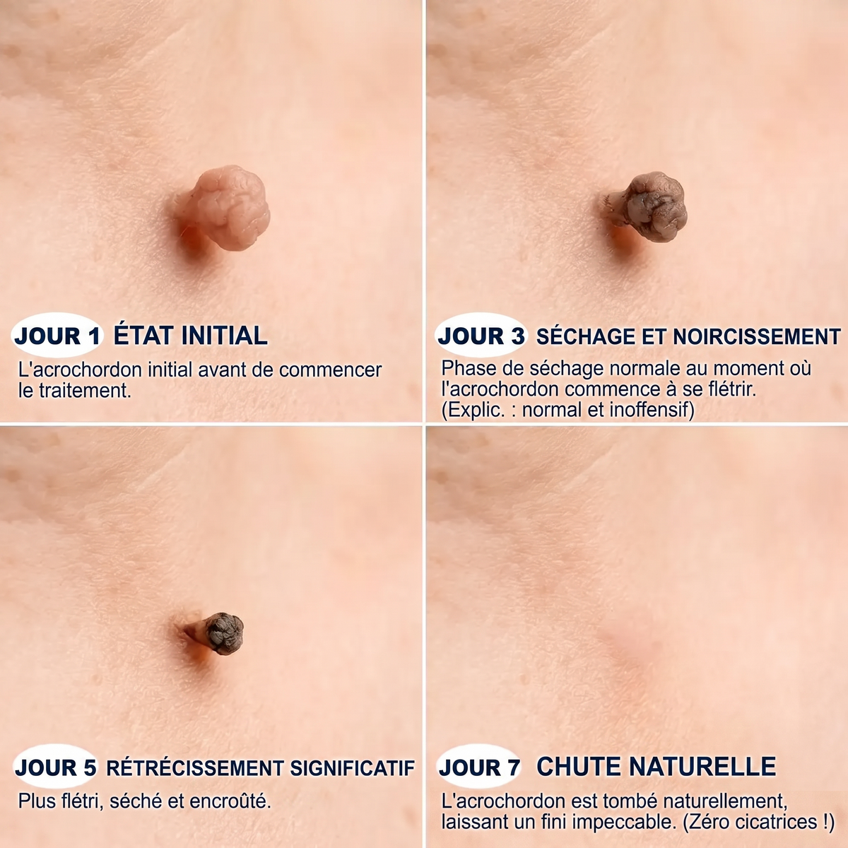【 Dernier jour : -70 % 🔥】🇫🇷 𝐇𝐞𝒂𝒍𝗿𝗶𝙯𝙚®🦋 𝑷𝒂𝒕𝒄𝒉 2-𝒆𝒏-1 à 𝒎𝒊𝒄𝒓𝒐-𝒂𝒊𝒈𝒖𝒊𝒍𝒍𝒆𝒔 & 𝒉𝒚𝒅𝒓𝒐𝒄𝒐𝒍𝒍𝒐ï𝒅𝒆 | Aide à réduire l’apparence des grains de beauté, verrues, acné et étiquettes cutanées | Patchs invisibles visage & corps.