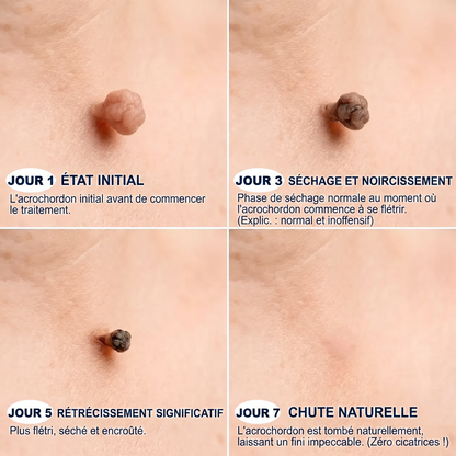 【 Dernier jour : -70 % 🔥】🇫🇷 𝐇𝐞𝒂𝒍𝗿𝗶𝙯𝙚®🦋 𝑷𝒂𝒕𝒄𝒉 2-𝒆𝒏-1 à 𝒎𝒊𝒄𝒓𝒐-𝒂𝒊𝒈𝒖𝒊𝒍𝒍𝒆𝒔 & 𝒉𝒚𝒅𝒓𝒐𝒄𝒐𝒍𝒍𝒐ï𝒅𝒆 | Aide à réduire l’apparence des grains de beauté, verrues, acné et étiquettes cutanées | Patchs invisibles visage & corps.